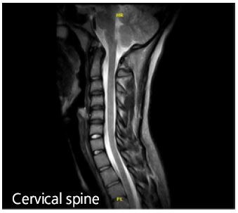 Cervical Spine Xray