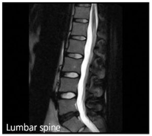 Xray of Lumbar spine
